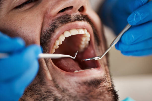 Best Emergency Wisdom Tooth Extraction in Chandler, TX